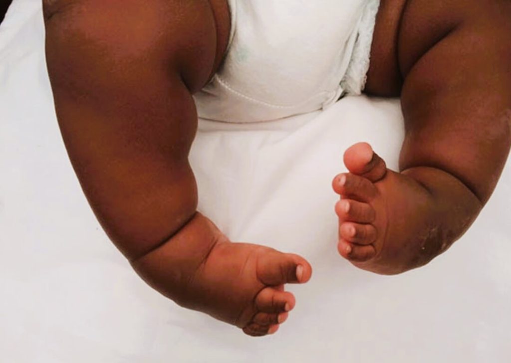 PLAN Foundation Urges Nigeria Government to Include Clubfoot Screening in Newborn Health Checks